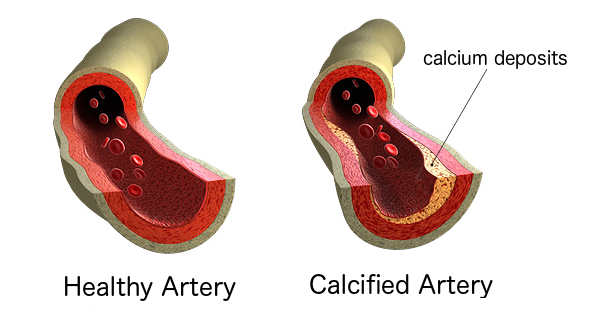 atherosclerosis